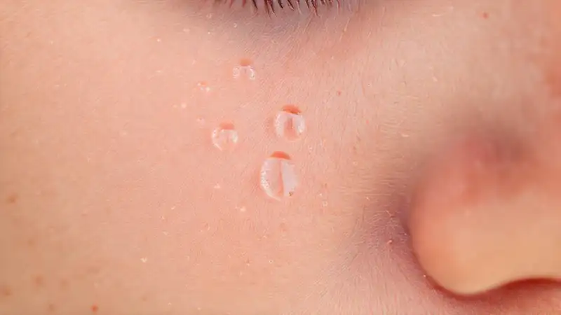 Piel sana, bacterias y calma